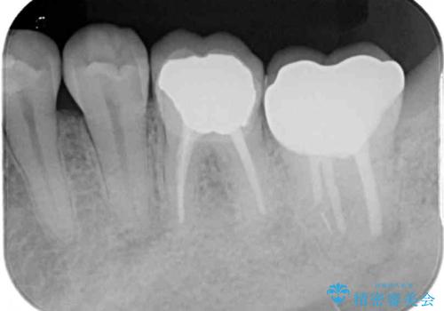 海外赴任前に治したい 割れてしまった奥歯のオールセラミッククラウンの治療後