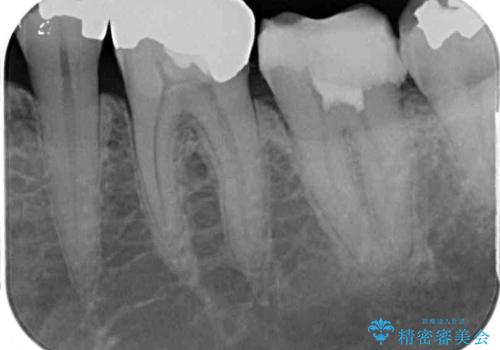 治療をしても違和感の続く奥歯　神経を極力残した虫歯治療の治療中