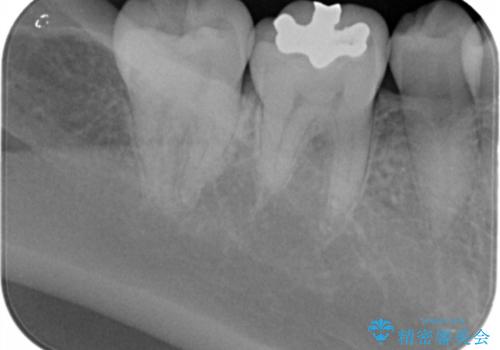 セラミックインレー治療の治療前