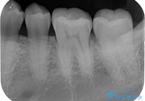 奥歯が欠けた セラミックインレーでの治療の治療後