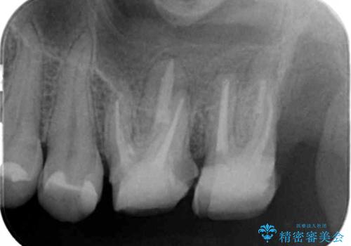 奥歯から臭いがする 銀歯下の虫歯再発の治療中