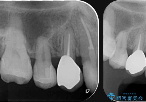 [ 歯肉縁下齲蝕 ]  歯周外科を行った虫歯治療の治療後