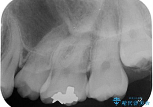 黒くなった奥歯をジルコニアクラウンにの治療前
