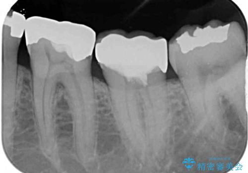 治療をしても違和感の続く奥歯 神経を極力残した虫歯治療の治療後