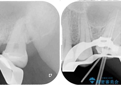 奥歯がズキズキと痛む 奥歯の虫歯治療の治療中