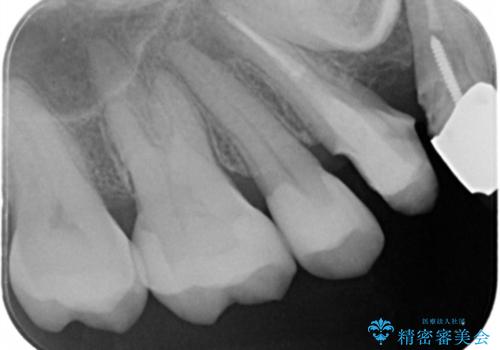 メタルインレーやりかえの治療後