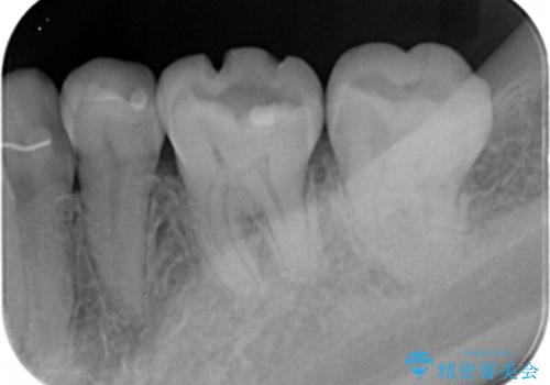 e-maxインレー治療の治療前
