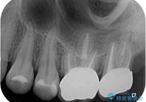 奥歯から臭いがする 銀歯下の虫歯再発の治療後