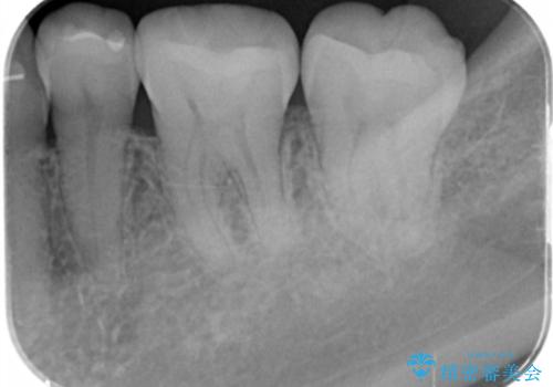 e-maxインレー治療の治療後