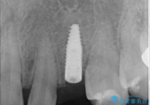 骨造成を伴う 前歯部インプラント治療の治療中