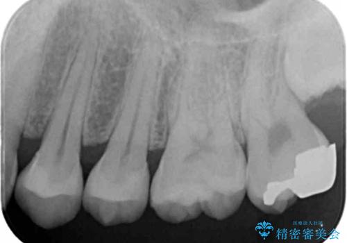 銀歯を目立たなくしたい セラミックインレーでの治療の治療後