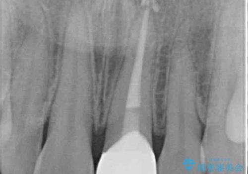 変色した前歯をオールセラミッククラウンにの治療後