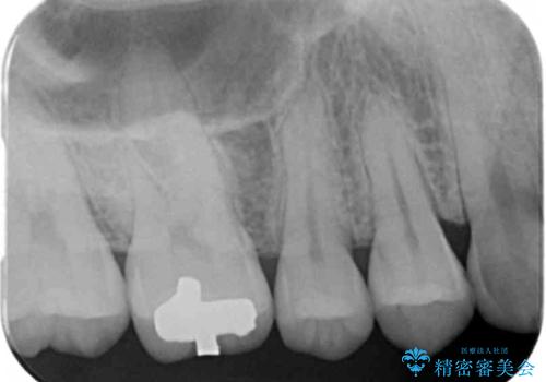 銀歯を白くしたい セラミックインレーでの治療の治療前