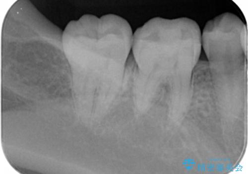 セラミックインレー治療の治療後