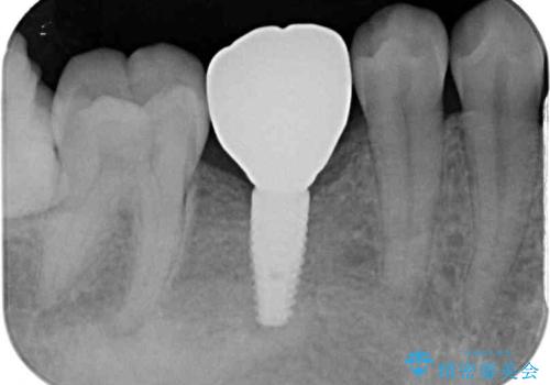 空いている時間を利用して通院 奥歯のインプラント治療の治療後