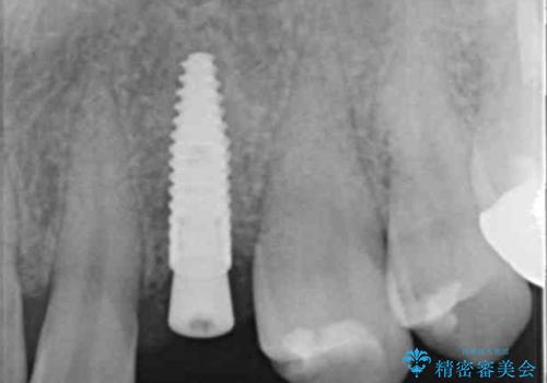 骨造成を伴う 前歯部インプラント治療の治療中