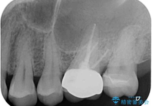 奥歯がズキズキと痛む 奥歯の虫歯治療の治療後