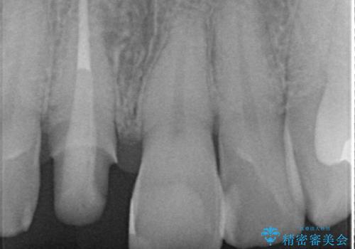 前歯の変色を改善!セラミック治療の治療中