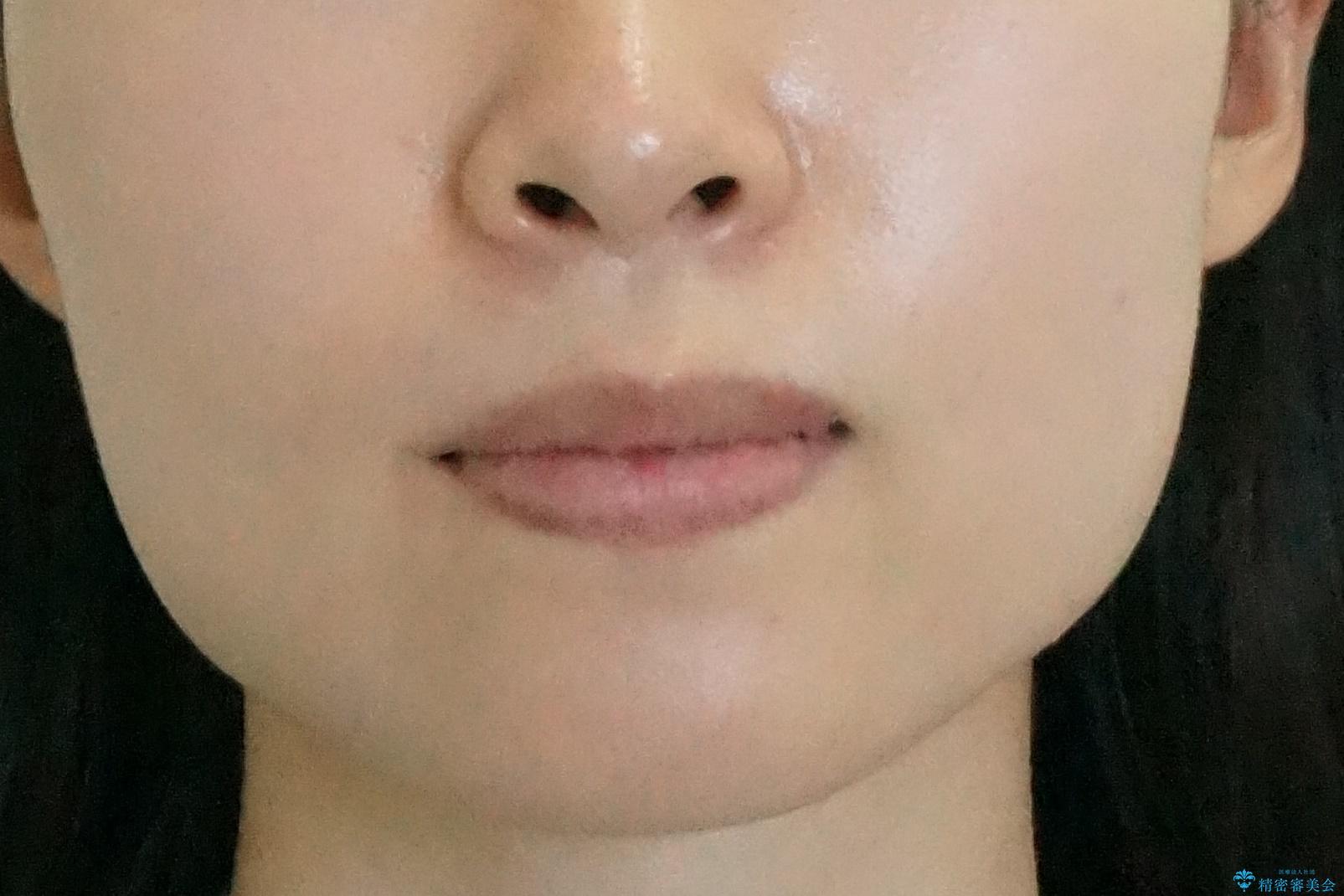 歯を抜かない矯正 出っ歯を抜かずに大きく下げることは可能です。の治療後(顔貌)