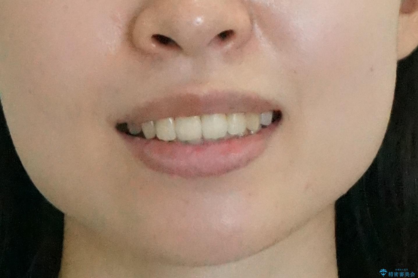 歯を抜かない矯正 出っ歯を抜かずに大きく下げることは可能です。の治療後(顔貌)