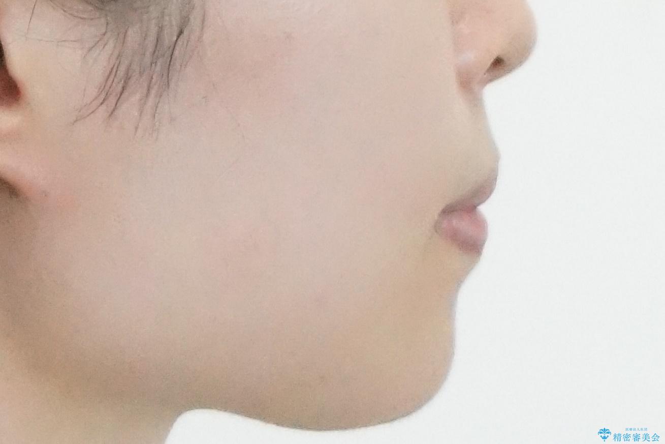 歯を抜かない矯正 出っ歯を抜かずに大きく下げることは可能です。の治療後(顔貌)