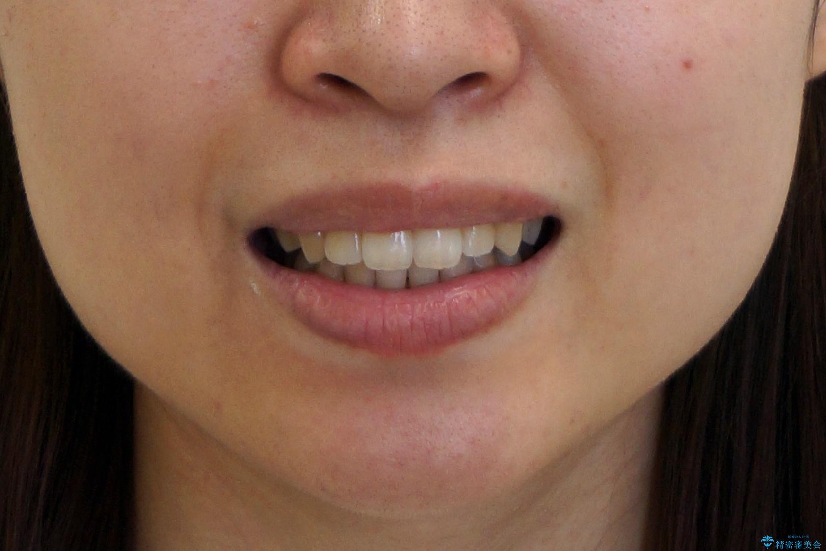 歯を抜かない矯正　出っ歯を抜かずに大きく下げることは可能です。の治療前（顔貌）