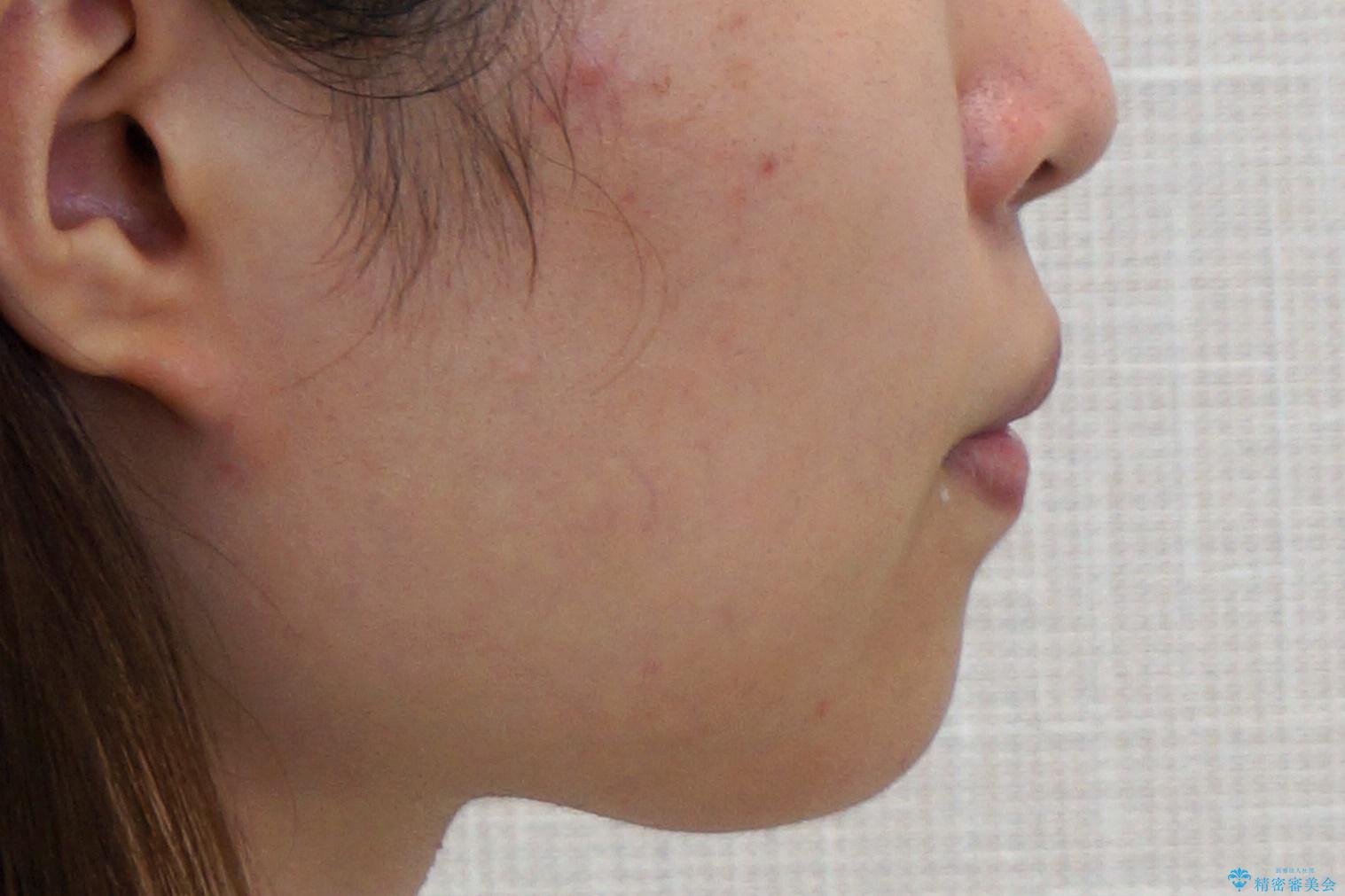 歯を抜かない矯正 出っ歯を抜かずに大きく下げることは可能です。の治療前(顔貌)