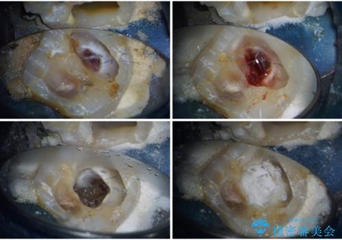 治療をしても違和感の続く奥歯 神経を極力残した虫歯治療の治療中