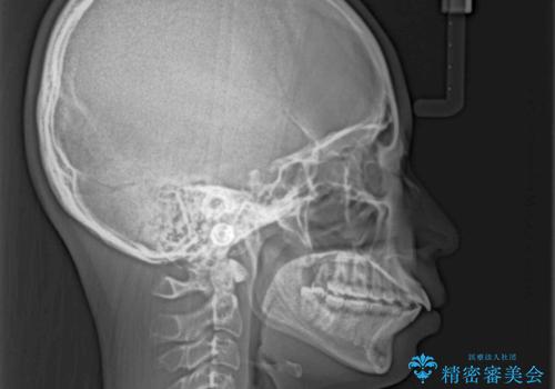口が閉じられない ワイヤー装置での抜歯矯正の治療前