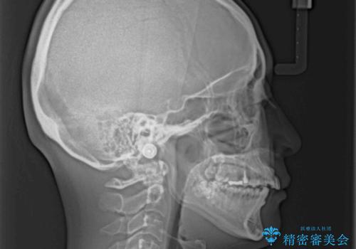 【モニター】飛び出た前歯を整えたい ワイヤー矯正治療の治療前