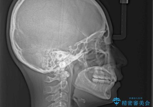 口が閉じられない ワイヤー装置での抜歯矯正の治療後