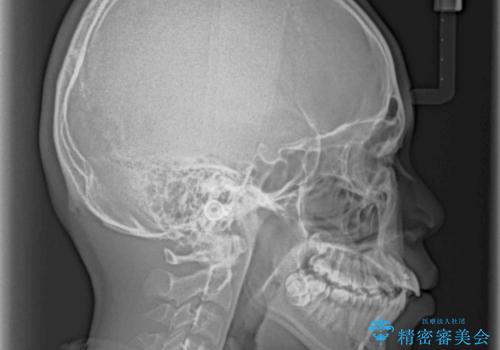 膨らんだ口元 ワイヤー装置での抜歯矯正の治療前