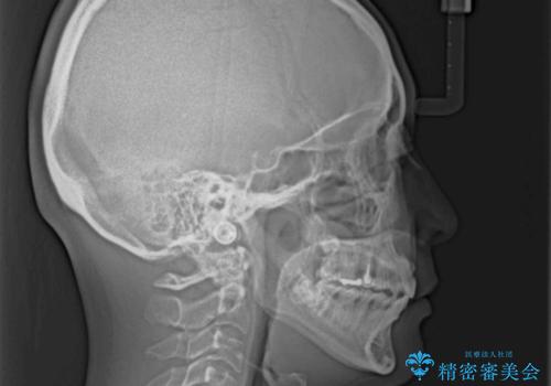 【モニター】飛び出た前歯を整えたい ワイヤー矯正治療の治療後
