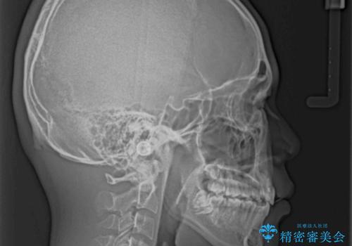 膨らんだ口元 ワイヤー装置での抜歯矯正の治療後