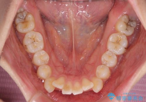 【モニター】口が閉じにくい 抜歯矯正で口元を引っ込めるの治療前