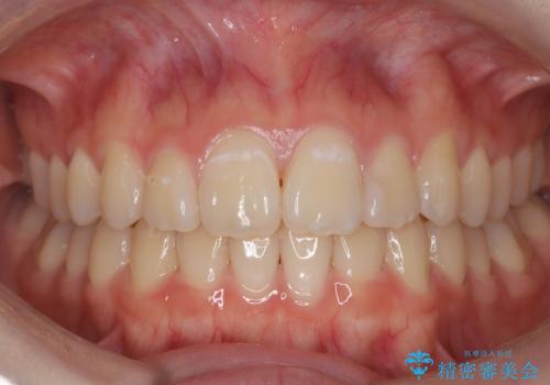 マウスピース矯正で前歯のガタツキを改善!　短期間で治療完了の症例 治療後