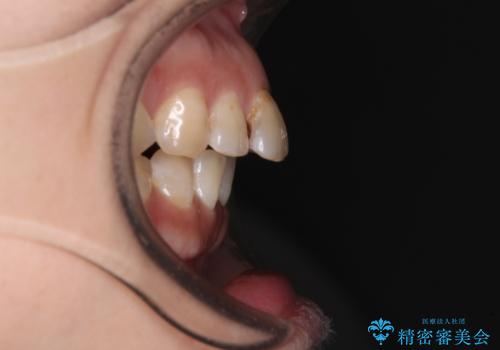 【モニター】飛び出た前歯を整えたい ワイヤー矯正治療の治療前