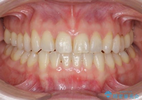 前歯の目立つガタつきをマウスピース矯正で治療の症例 治療後