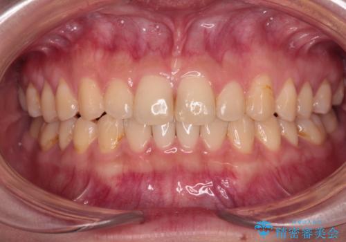 治療途中の奥歯と矯正治療の後戻り インビザライン・ライトによる矯正治療の症例 治療後