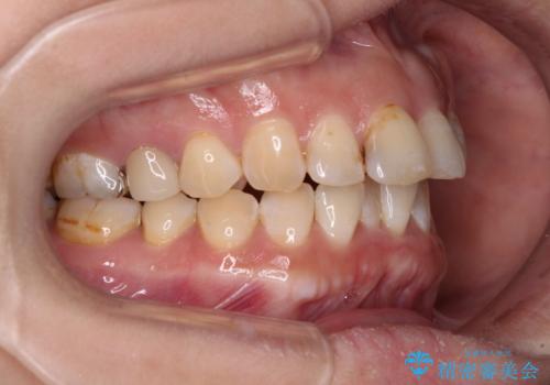 【モニター】飛び出た前歯を整えたい ワイヤー矯正治療の治療前