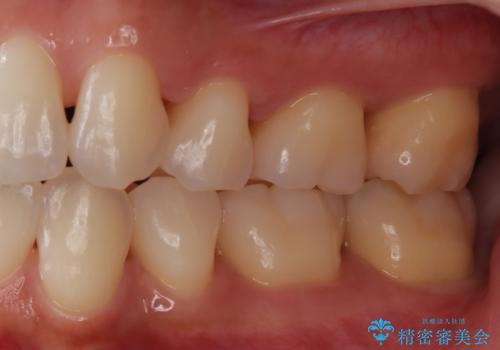 歯周病治療【オープンフラップ】の治療後