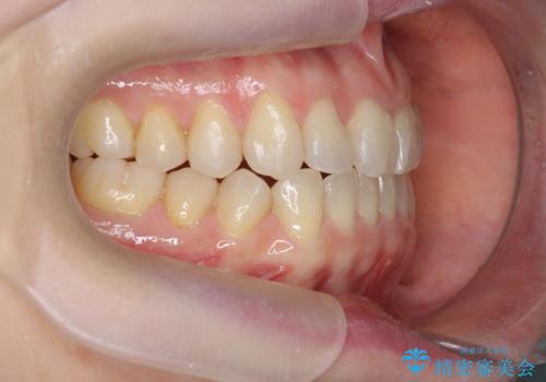 前歯の目立つガタつきをマウスピース矯正で治療の治療後