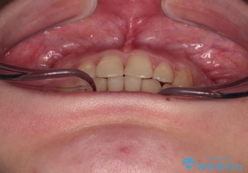 治療途中の奥歯と矯正治療の後戻り インビザライン・ライトによる矯正治療の治療後