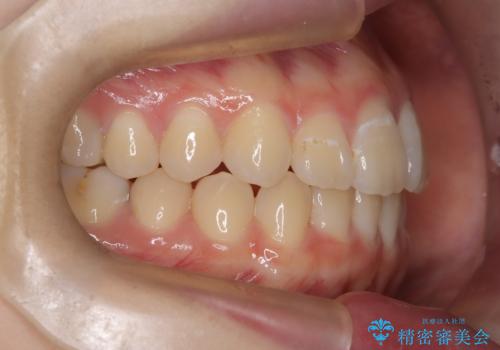 マウスピース矯正で前歯のガタツキを改善! 短期間で治療完了の治療後