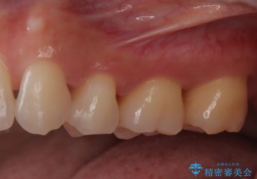 歯周病治療【オープンフラップ】の治療後