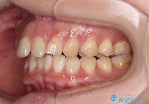 【モニター】飛び出た前歯を整えたい ワイヤー矯正治療の治療前