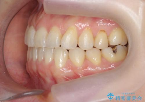 前歯の目立つガタつきをマウスピース矯正で治療の治療後