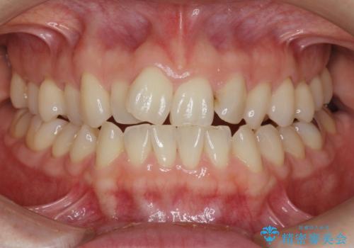 前歯の目立つガタつきをマウスピース矯正で治療の症例 治療前