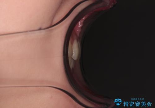 治療途中の奥歯と矯正治療の後戻り インビザライン・ライトによる矯正治療の治療後