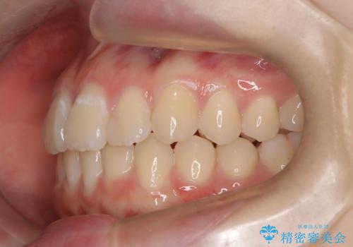 マウスピース矯正で前歯のガタツキを改善! 短期間で治療完了の治療後